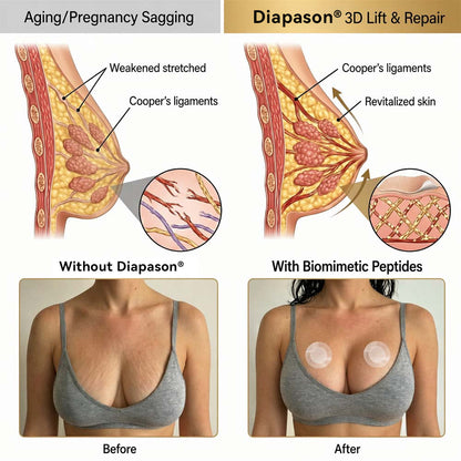 💥Diapason® 💥𝐁𝐑𝐄𝐀𝐒𝐓 𝐕𝐎𝐋𝐔𝐌𝐄 𝐁𝐎𝐎𝐒𝐓 & 𝐅𝐈𝐑𝐌 𝐌𝐈𝐂𝐑𝐎-𝐍𝐄𝐄𝐃𝐋𝐄 𝐏𝐀𝐓𝐂𝐇𝐄𝐒💥💥💥
