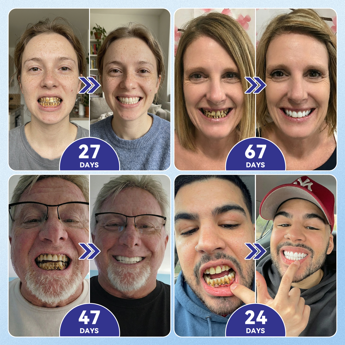 Next-Gen🦷𝐆𝐥𝐢𝐦𝐦𝐞𝐫𝐥𝐲® 𝐓𝐢𝐝𝐞𝐠𝐥𝐮𝐬𝐢𝐛 𝐓𝐨𝐨𝐭𝐡 & 𝐆𝐮𝐦 𝐑𝐞𝐩𝐚𝐢𝐫 𝐌𝐢𝐜𝐫𝐨𝐧𝐞𝐞𝐝𝐥𝐞 𝐏𝐚𝐭𝐜𝐡  | 𝐀𝐝𝐯𝐚𝐧𝐜𝐞𝐝 𝐒𝐭𝐞𝐦-𝐂𝐞𝐥𝐥 𝐀𝐜𝐭𝐢𝐯𝐚𝐭𝐢𝐨𝐧 𝐓𝐞𝐞𝐭𝐡 𝐒𝐭𝐫𝐢𝐩𝐬(🦷𝐑𝐞𝐛𝐮𝐢𝐥𝐝 𝐄𝐧𝐚𝐦𝐞𝐥 & 𝐃𝐞𝐧𝐭𝐢𝐧 • 𝐒𝐭𝐫𝐞𝐧𝐠𝐭𝐡𝐞𝐧 𝐆𝐮𝐦𝐬 • 𝐄𝐫𝐚𝐝𝐢𝐜𝐚𝐭𝐞 𝐓𝐚𝐫𝐭𝐚𝐫 & 𝐎𝐝𝐨𝐫 • 𝐒𝐭𝐨𝐩 𝐓𝐨𝐨𝐭𝐡 𝐒𝐞𝐧𝐬𝐢𝐭𝐢𝐯𝐢𝐭𝐲)